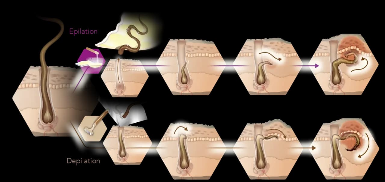 Eingewachsene Haare Intimbereich: Ursachen, Behandlung & Vorbeugung